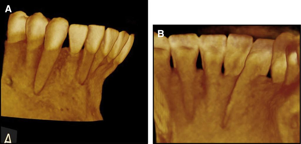 Initial alignment before soft tissue grafting of the mandibular right central incisor area: A, frontal view; B, occlusal view; C, 2 weeks after soft tissue grafting, the initial periodontal surgery.