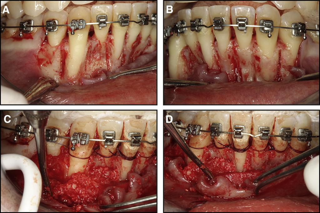 Progress of treatment: A and B, healing after second surgery; C and D, improvement of root torque a few months later. Fig 18.