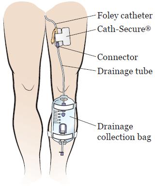 PATIENT & CAREGIVER EDUCATION Caring for Your Urinary (Foley ) Catheter This information will help you care for your urinary (Foley ) catheter while you re at home.