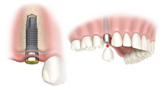 Schedule your dental implant consultation to find out more. Implant Supported Dentures Attention denture sufferers.