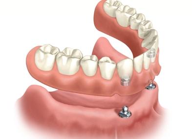 Is the full coverage palate in your top denture taking up too much space, gagging you and ruining the taste of food?