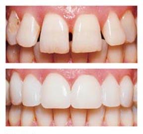 Porcelain Veneers Are your teeth stained, chipped and unattractive? Do you want a Hollywood smile that others envy?