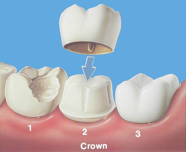 Dental crowns Broken tooth? Old crown with ugly black line on the bottom? Had a root canal on a back tooth recently? These may be indications for a dental crown.