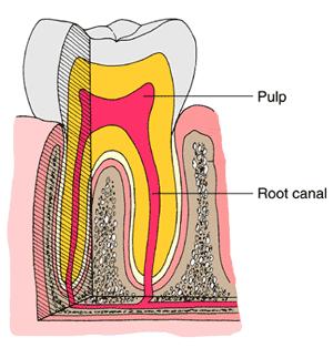 Root Canals Does your tooth hurt? Has a small cavity become too deep or caused your tooth to fracture? By performing root canal therapy, a tooth can be saved.