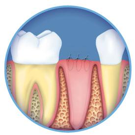 If you are in pain, call us right away so that we can schedule you an emergency appointment. Dental Extraction Is your tooth completely broken down?