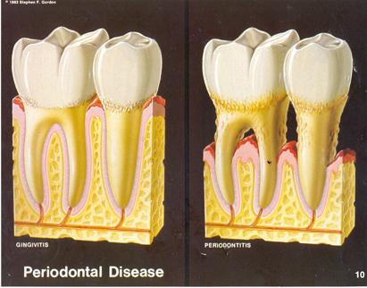 Scaling and Root Planing Bleeding gums, heavy calculus, and bad breath may be signs of periodontal disease. Something you should get under control.