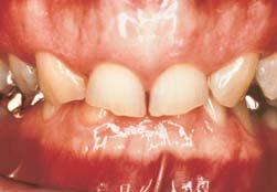 EXTRAORDINARY! Are your teeth discolored? Yellow or stained?