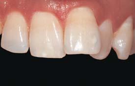 Do your teeth have unusual spaces between them?
