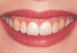 Are your teeth crooked or overlapping one another?