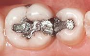 inlays/onlays Ask your dentist how you