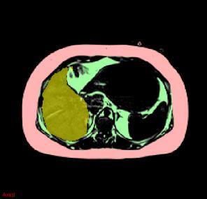 Predicting fatty liver syndrome Defining our target: liver fat