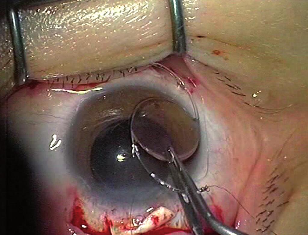 low-up showed that intrascleral fixation of one haptic alone offers IOL fixation stability.