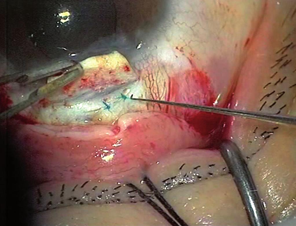 Dislocation of scleral-fixated posterior chamber intraocular lens. Fig.