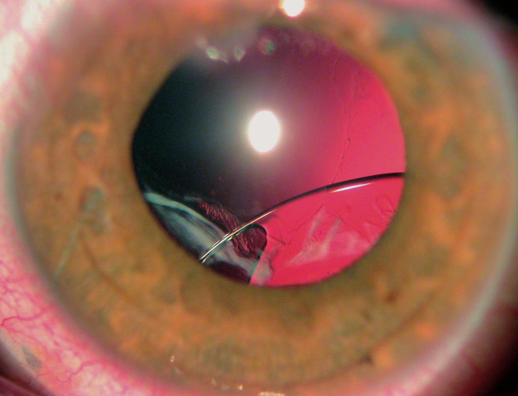 intrascleral fixation of the upper haptic.