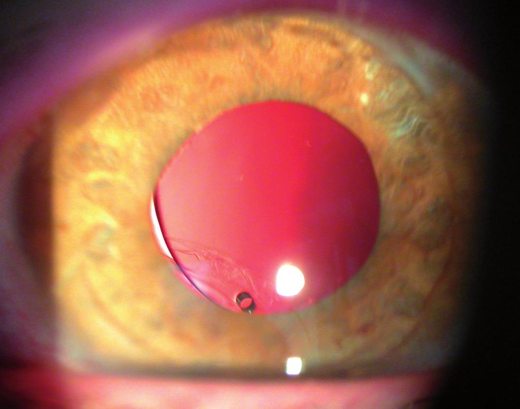 Slight injection of the eyeball was marked, corneal and vitreous transparency was restored.
