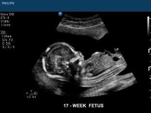 Note the anatomical details of this 17-week fetus.