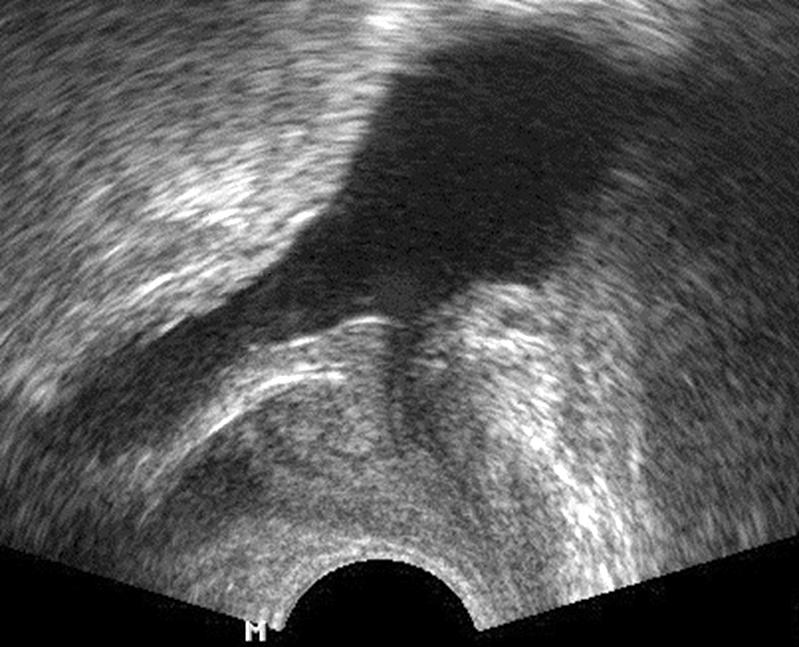 488 Park et al Observation of a thickened or trabeculated bladder wall is considered to be of great significance in the diagnosis of obstruction.