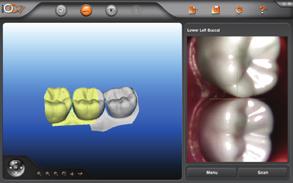 Scan 3: Move along the dentition and capture scans in order to build a complete digital model on the screen.