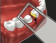 Scanning the preparation Occlusal The initial scans of the preparation are critical to obtaining a good result.
