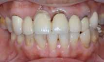 Subepithelial connective tissue and onlay grafts are designed to enhance ridge height and width, making them useful for treating Class III deformities.