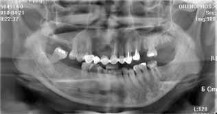 The six-unit fixed partial denture (FPD) between the bilateral maxillary canines with pontic space on tooth 12 was already more than ten years old.