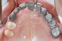 PFM FPD (teeth 24 to 26), and three single PFM FPDs (teeth 22,