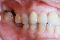 Seibert described the use of a thick free gingival onlay graft to enhance ridge height and replace disfigured or traumatized tissue.