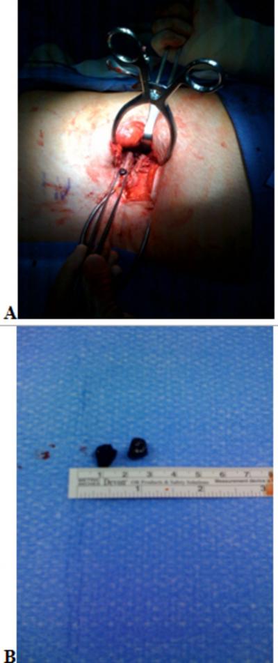 Figure 3 Figure 3: () First of two gallstones extracted during surgical exploration of right-flank wound with patient in left lateral decubitus position.