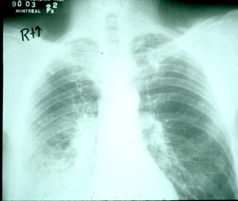55 y.o. Male, R Mid+Lower Lung Ca.
