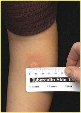 TST skin test interpretation depends on two factors: Measurement in millimeters of induration Person s risk of being infected with TB and of progression to disease if infected An induration of 5 or