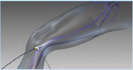 The Venefit Procedure Using the ClosureFast Catheter Minimally invasive