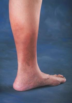 No visible or palpable signs of venous