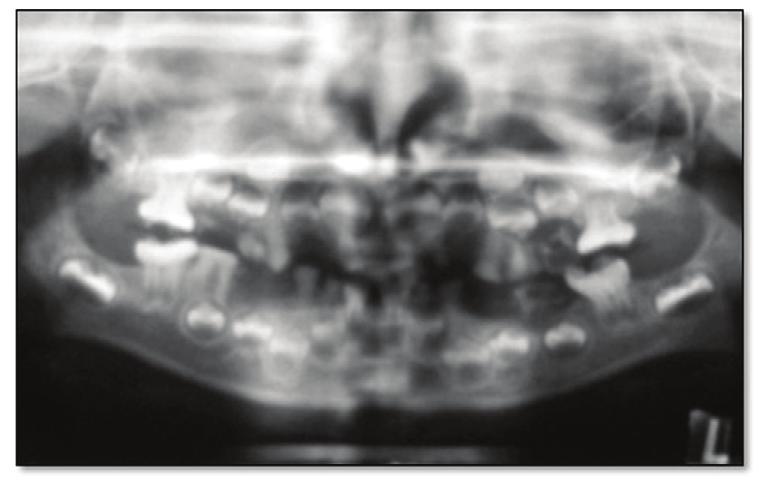 Figure 3. Panoramic radiograph of the seven-year old child. Figure 4. Panoramic radiograph of patient s mother. molars.