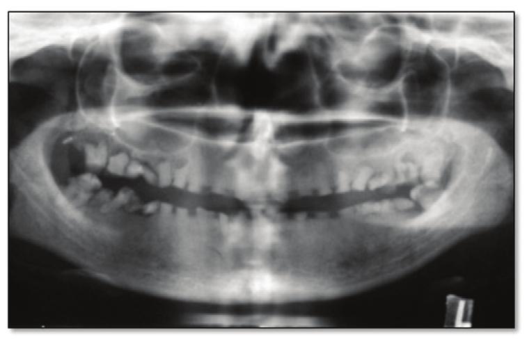 Similar levels of attrition and a yellowish-brown opalescent hue to the exposed dentin were seen in the permanent dentition of the mother (Figure 2).