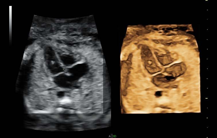 SRI CrossXBeam CRI HD-Flow Dual-view 1 2 3 4 5 Expect more from your 2D images For all the advances in ultrasound, 2D imaging is still the backbone of Women's Health exams.