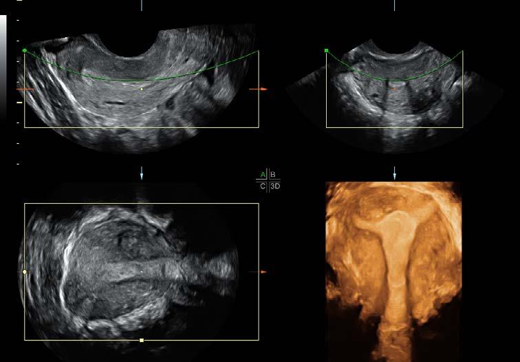 1 2 3 4 5 SRI CrossXBeam CRI HD-Flow Dual-view Multiplanar rendering of uterus Back Expect more from your 2D images For all the advances in ultrasound, 2D