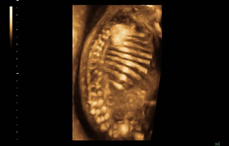 1 2 3 4 5 SRI CrossXBeam CRI HD-Flow Dual-view Rendered fetal spine and ribs Back Expect more from your 2D images For all the advances in ultrasound, 2D