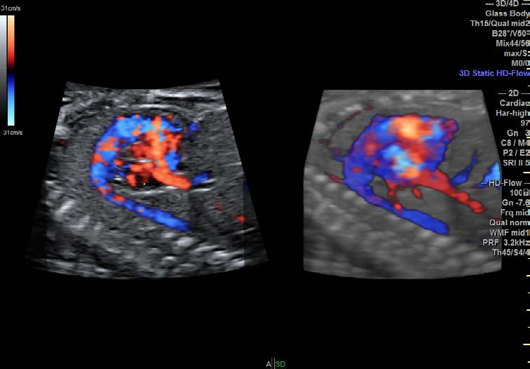 Gain confidence in volume ultrasound Dual-view allows simultaneous visualization of
