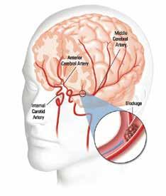 Your Guide to Ischemic Stroke What happened to me? You had a stroke. The stroke you had was most likely an ischemic (is-keem-ik) stroke, the most common type of stroke.