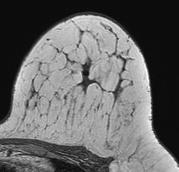 Final pathology revealed 2 mm residual focus