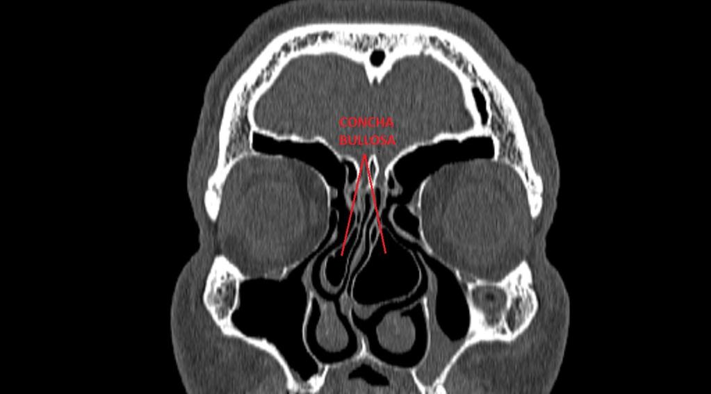 Fig. 4: Coronal CT image shows an anatomic variant - concha bullosa representing pneumatized middle turbinate.
