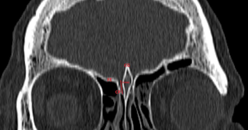 6: Coronal CT image shows lamina papyracea (LP) one of the structures that can be potentially
