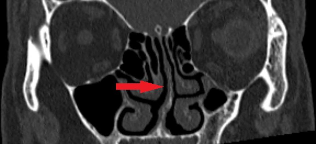 Fig. 1: Coronal CT image shows normal anatomy: nasal septum (NS), inferior turbinate (IT), middle turbinate (MD), ethmoid bulla (BE) and maxillary sinus (Max).