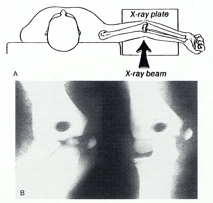 Imaging Studies Radiographs Calcification of MCL