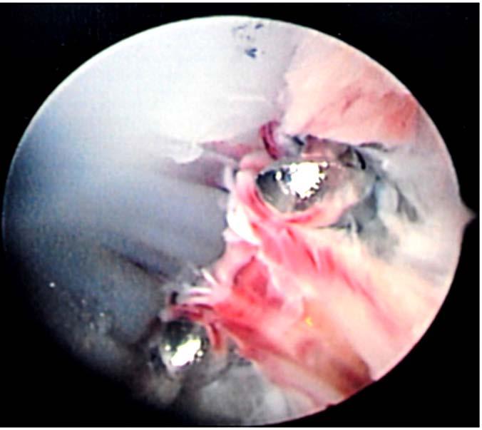 Arthroscopic picture showing synovitis