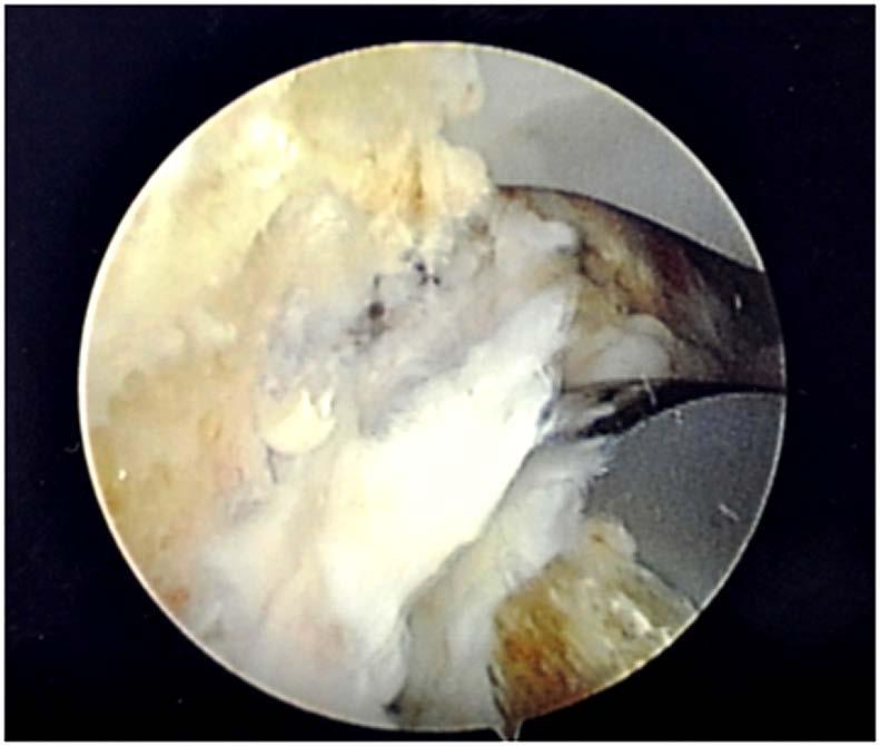 Arthroscopic picture showing