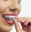 Step 4: Wear your aligners. You ll receive your first aligner and then switch to a new aligner every two weeks as your teeth move.
