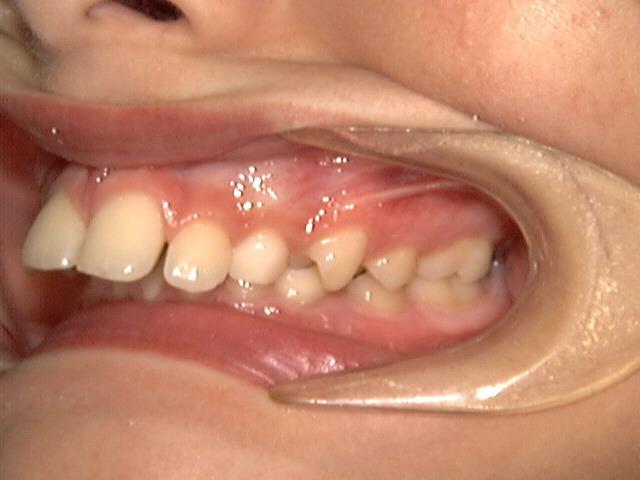 Open bite: An open bite results when the upper and lower front teeth do not touch when biting down.