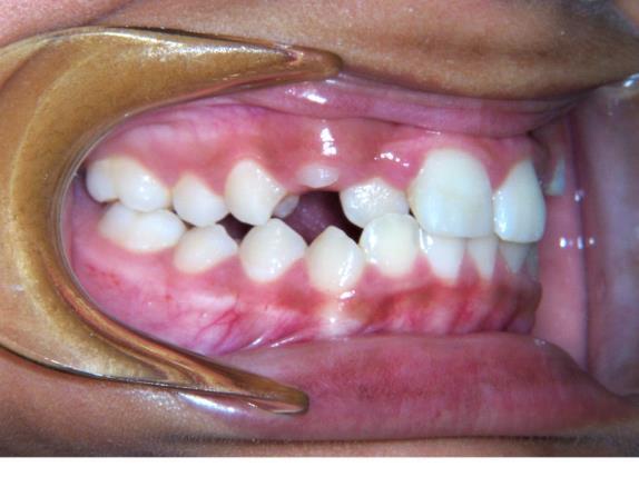 Spacing: If teeth are missing or small for the mouth, space between the teeth can occur.