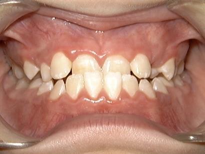 Crossbite: The most common type of a crossbite is when the upper teeth bite inside the lower teeth (toward